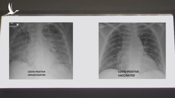 So sánh ảnh chụp phổi của bệnh nhân COVID-19 đã tiêm và chưa tiêm vaccine, phát hiện điều kinh ngạc