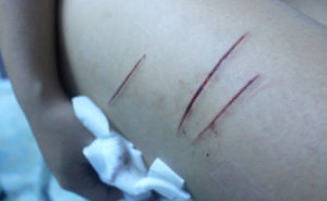 Xuất hiện đối tượng chuyên rạch đùi phụ nữ tại Đồng Tháp Xuất hiện đối tượng chuyên rạch đùi phụ nữ tại Đồng Tháp