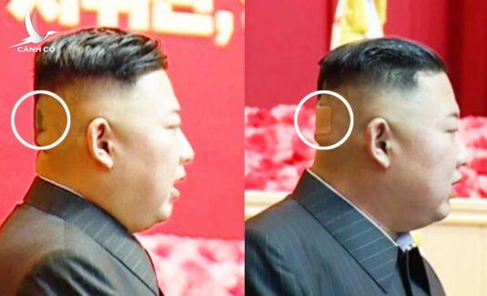 Ông Kim Jong-un bất ngờ xuất hiện với băng dán sau đầu